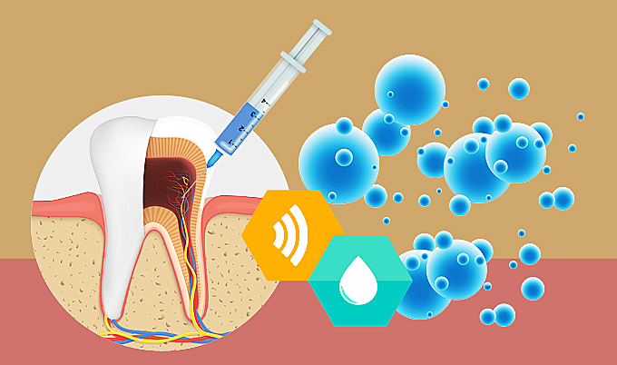 Intracanal Endo Treatment