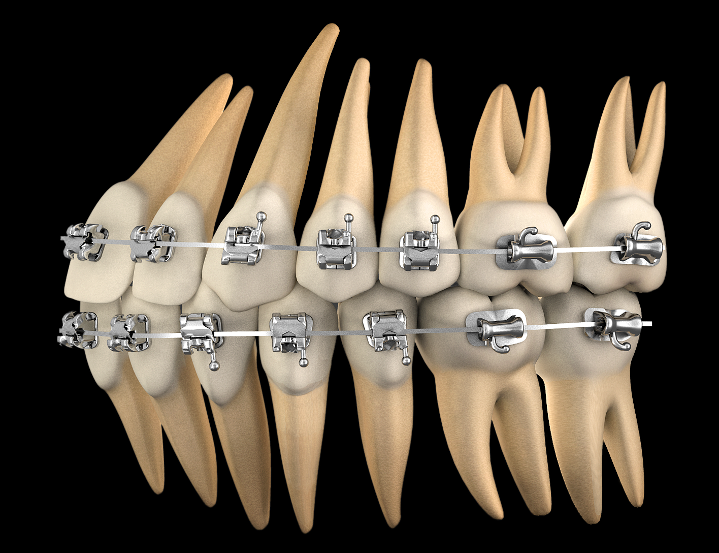Self-Ligating Brackets Course with CCO System | Universitat ...